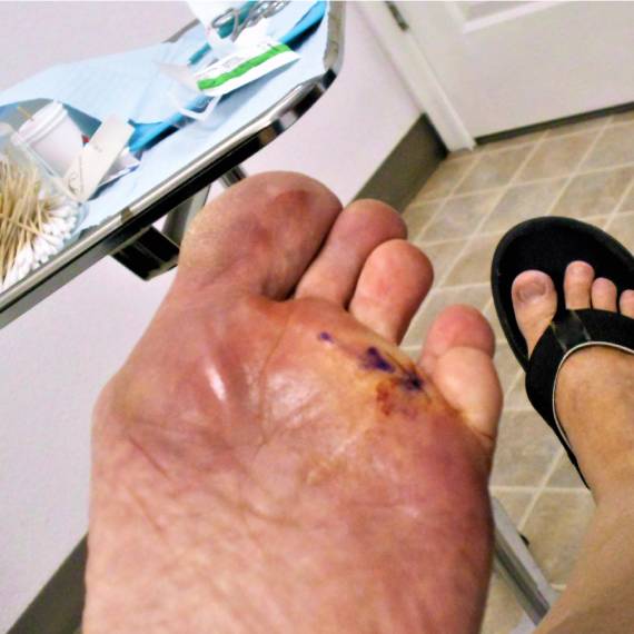 Curación de heridas por pie diabético